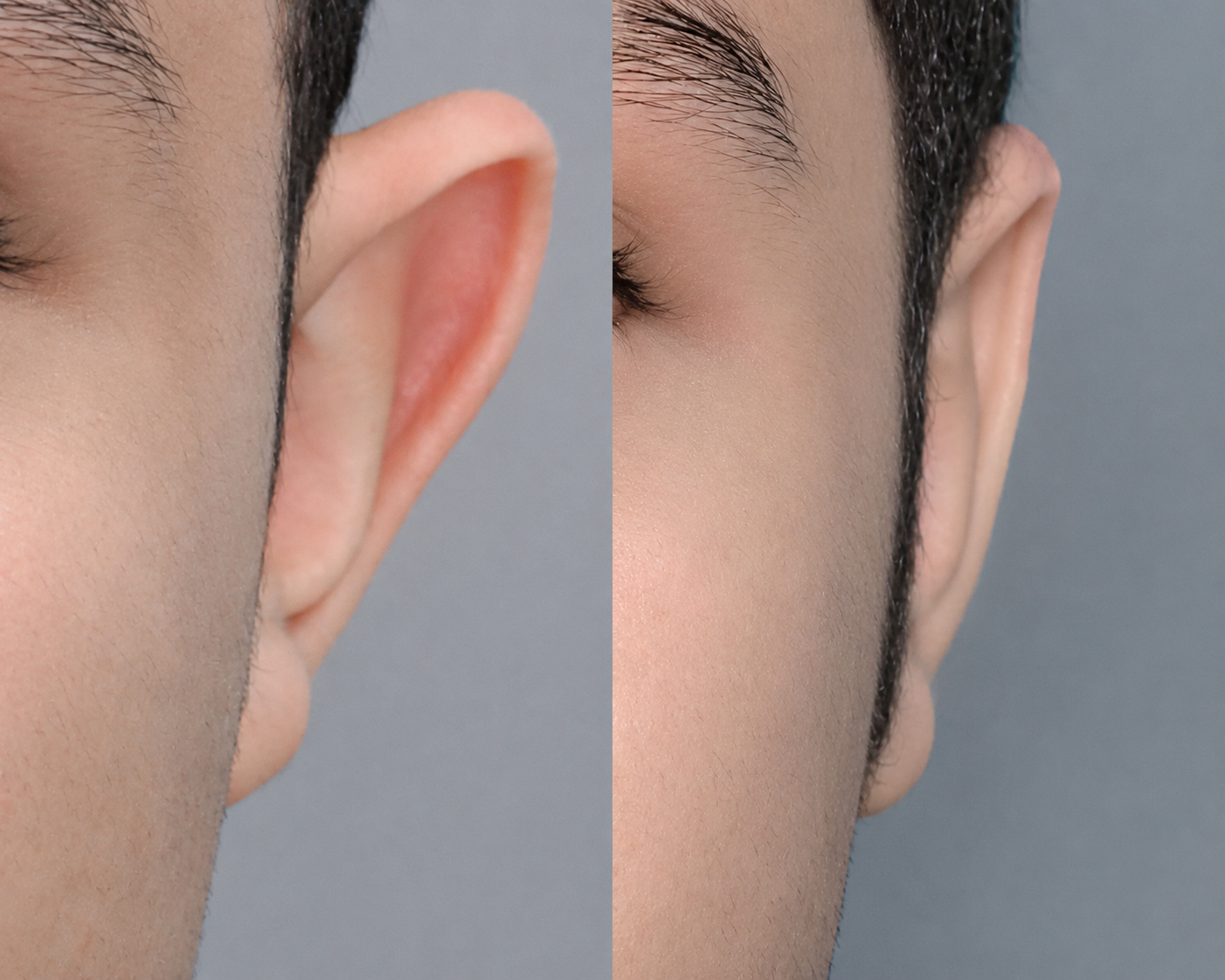 Otoplastia: harmonia das orelhas com o rosto